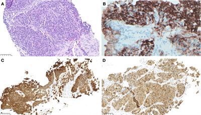 Response to selpercatinib in a patient with RET fusion-positive pulmonary large-cell neuroendocrine carcinoma: A case report